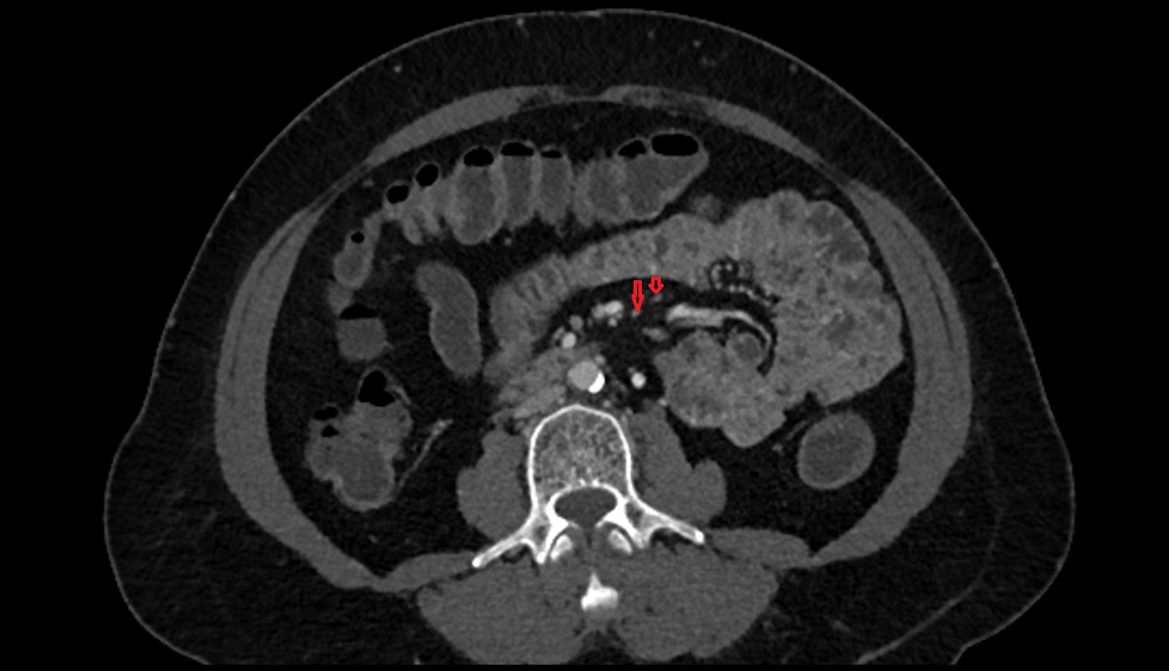 Ileal arteries axial ct image