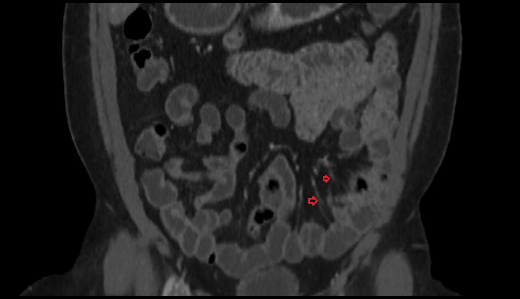 Ileal arteries coronal ct image