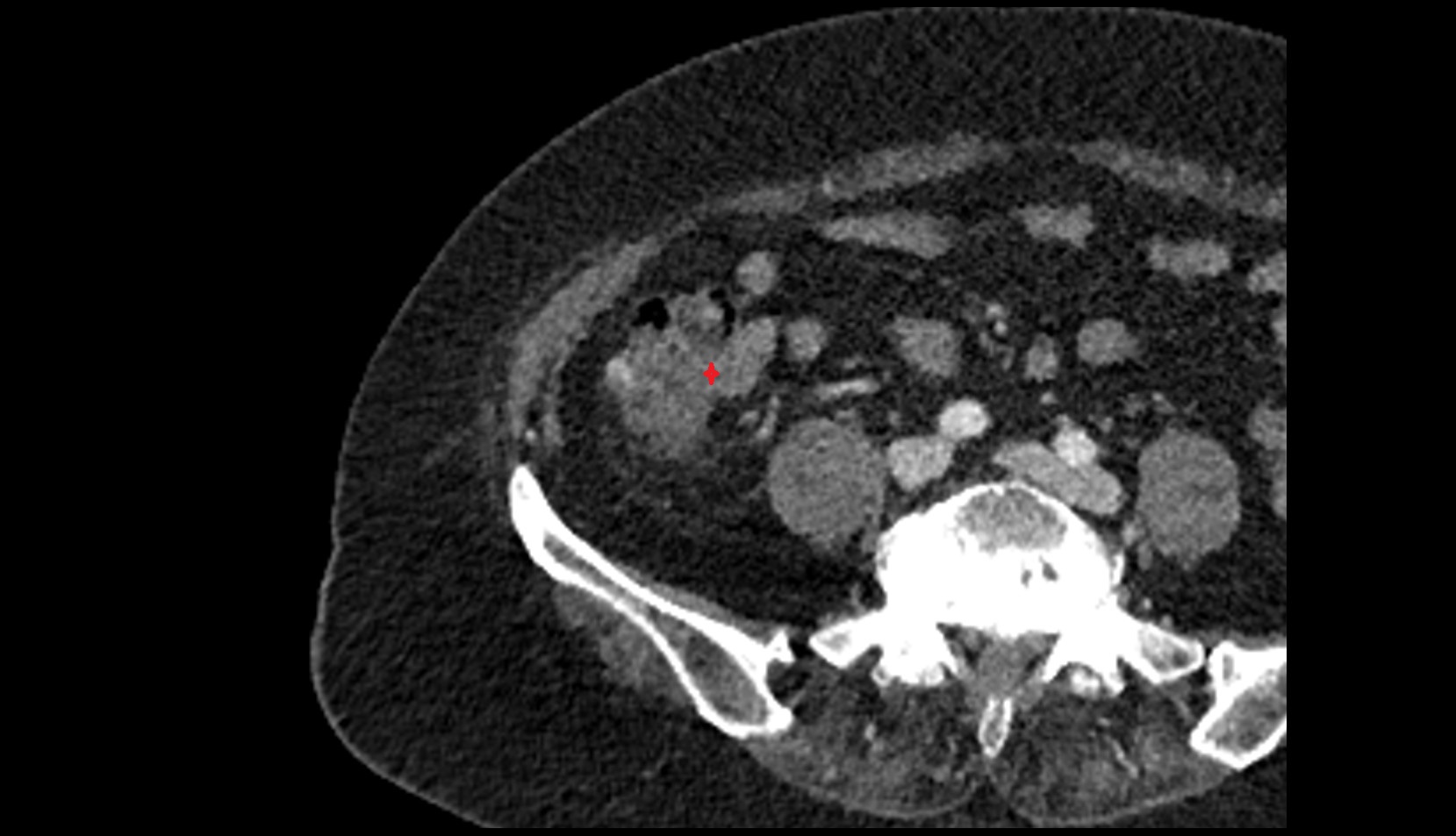 Ileocaecal valve CT axial image