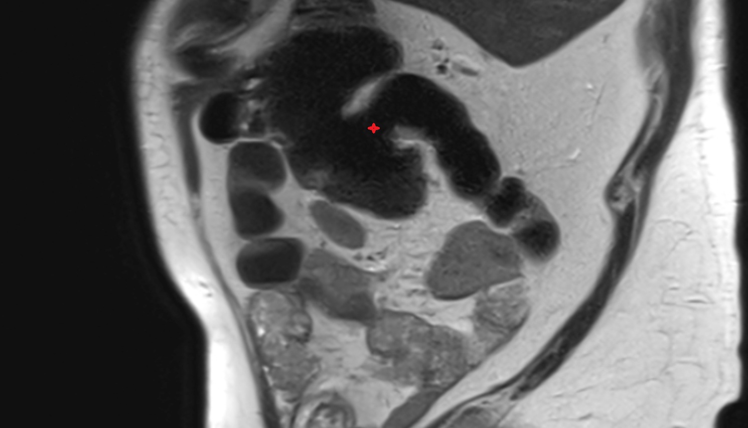 Ileocaecal valve sagittal mri  anatomy  image -img-00000-00000