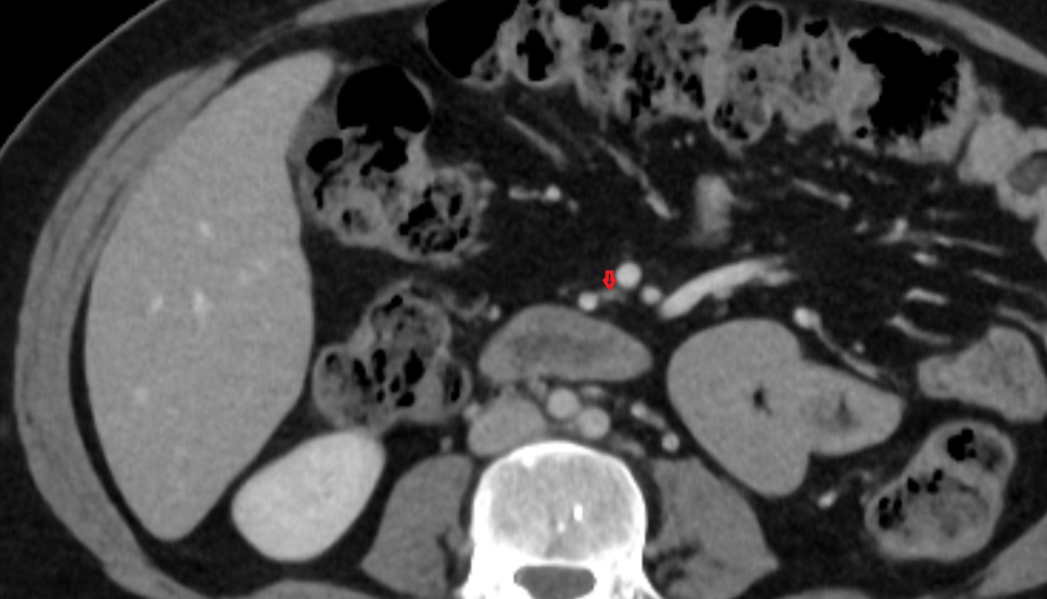 Ileocolic artery CT axial anatomy  image -img-00000-00000