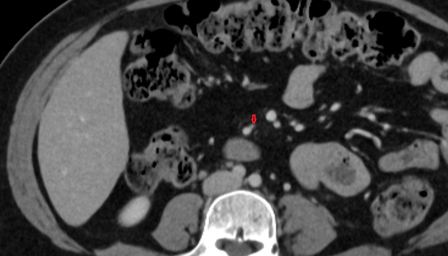 Ileocolic artery CT axial anatomy  image -img-00000-00000_00001