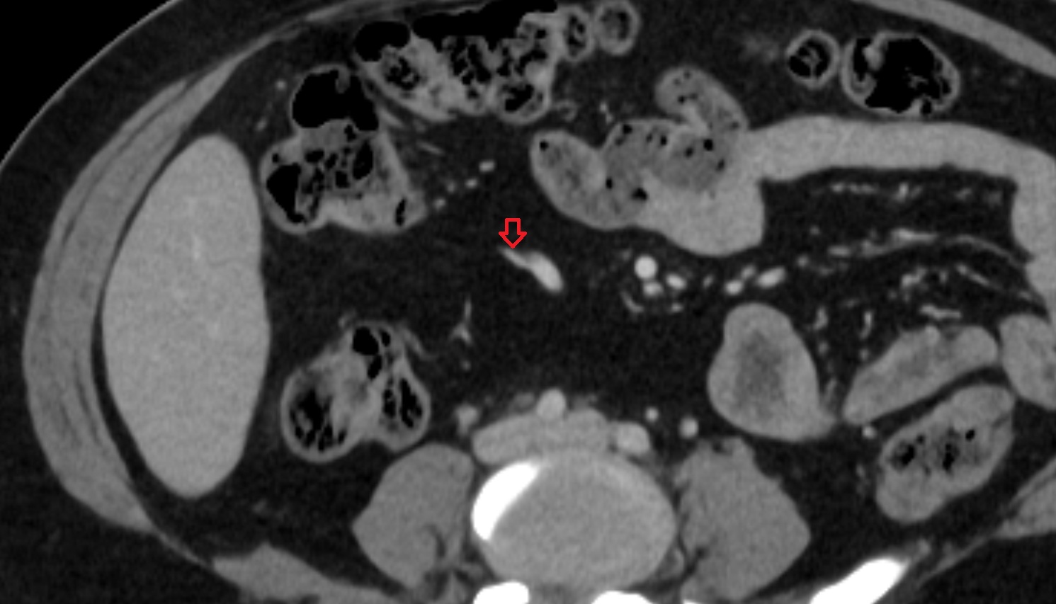 Ileocolic artery CT axial anatomy  image -img-00000-00000_00002
