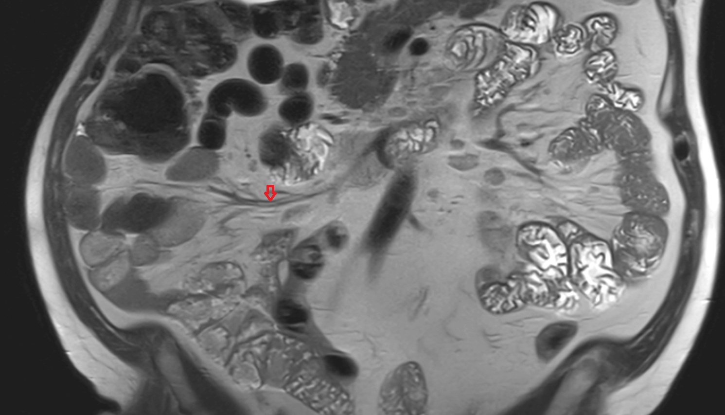 Ileocolic artery MRI coronal anatomy  image -img-00000-00000