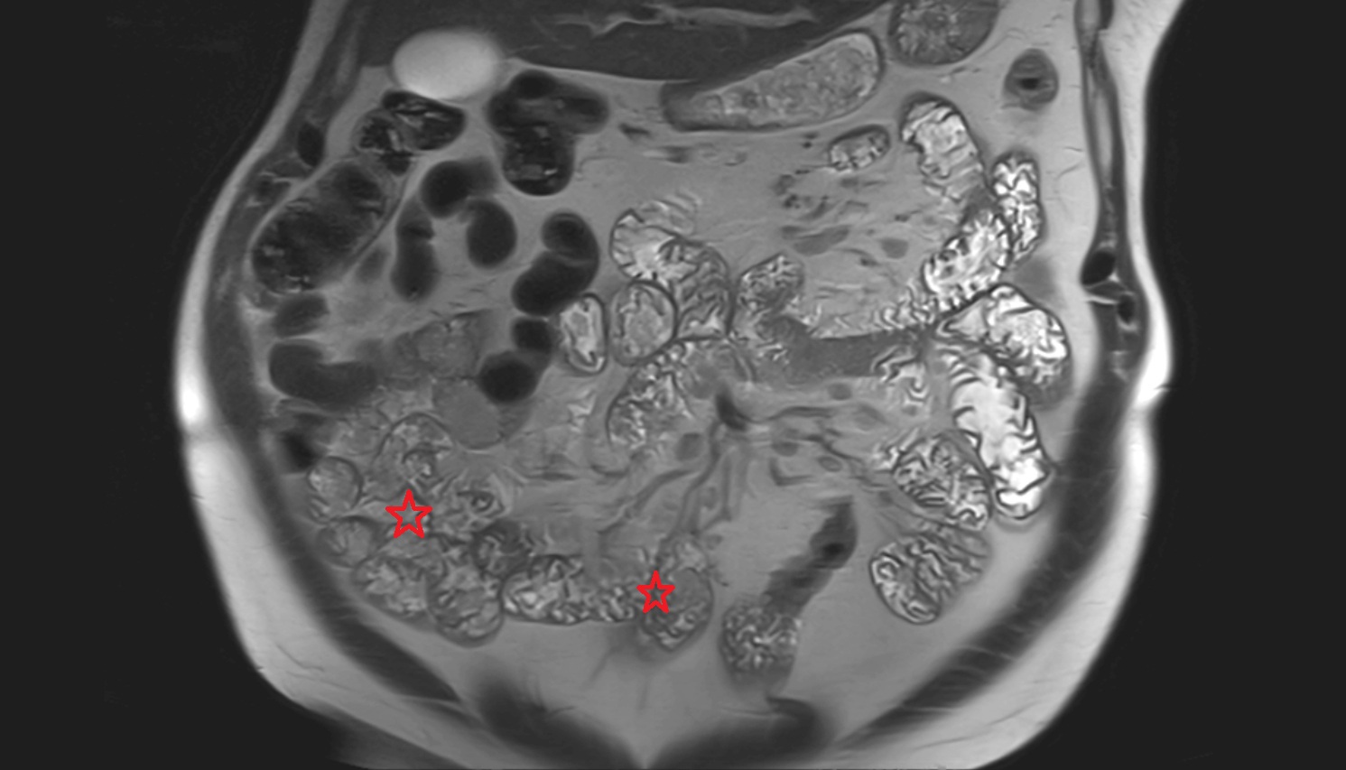 Ileum MRI coronal  anatomy  image -img-00000-00000