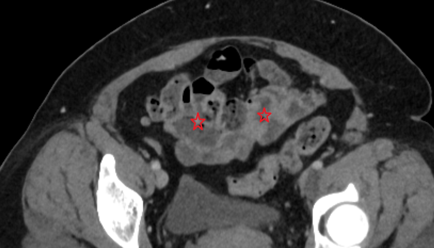 Ileum  ct axial  anatomy  image -img-00000-00000