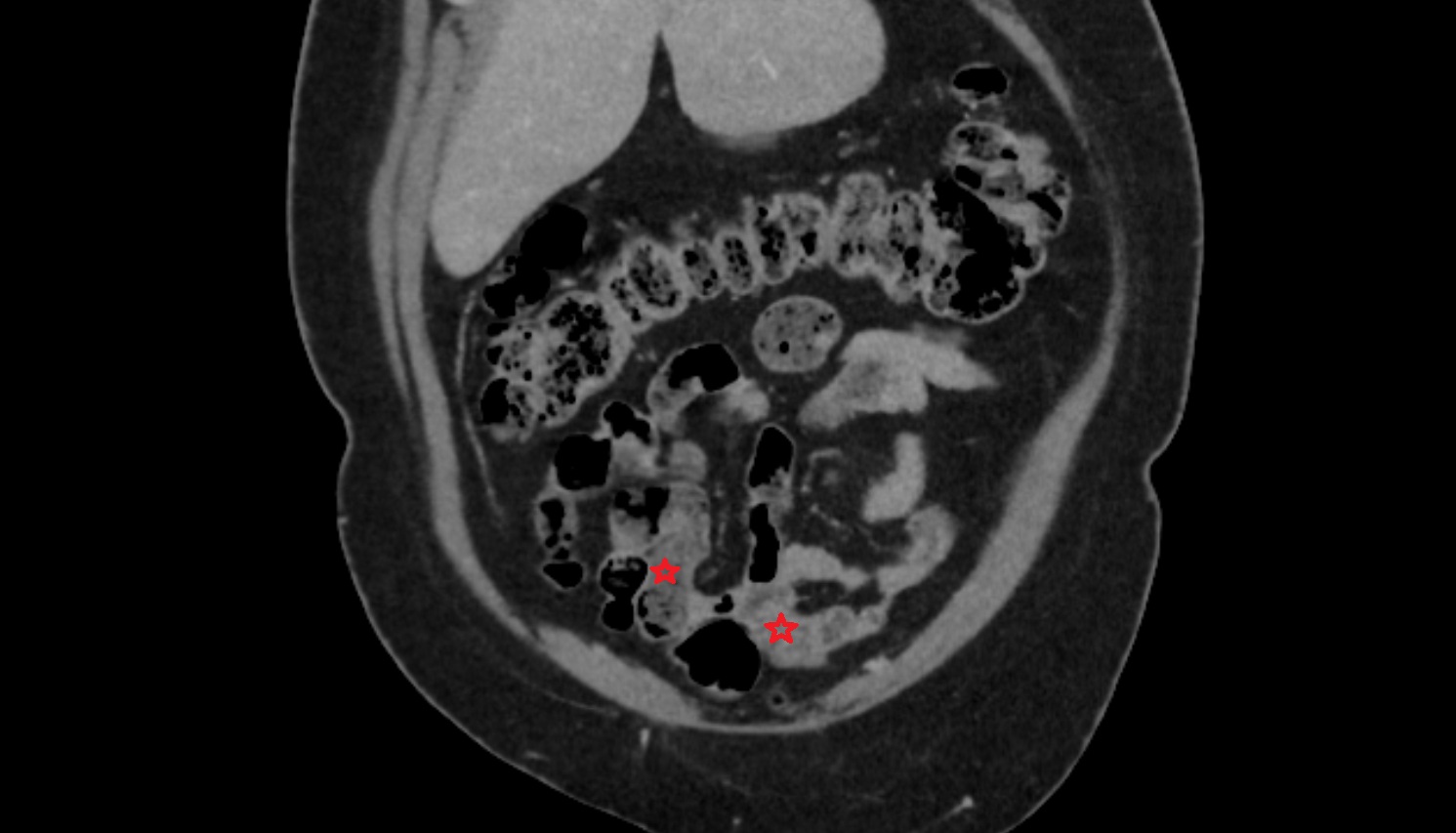 Ileum,  ct coronal  anatomy  image -img-00000-00000
