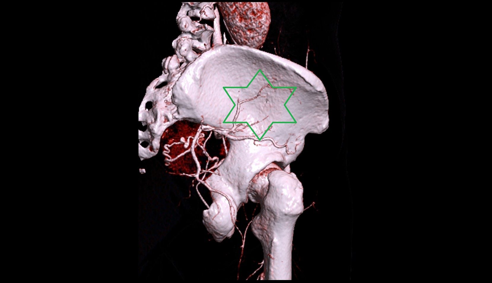 Iliac bone 3d image