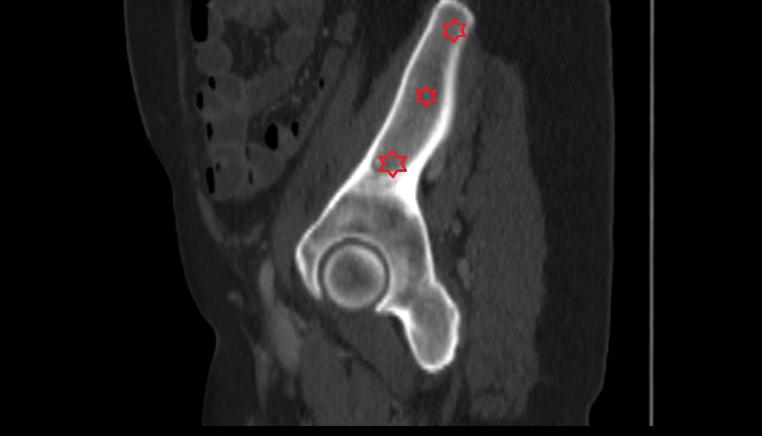 Iliac bone ct anatomy  Location and Imaging Appearance  -img-00000-00000