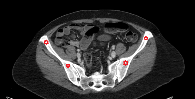Iliac bone ct anatomy  Location and Imaging Appearance  -img-00000-00000_00001