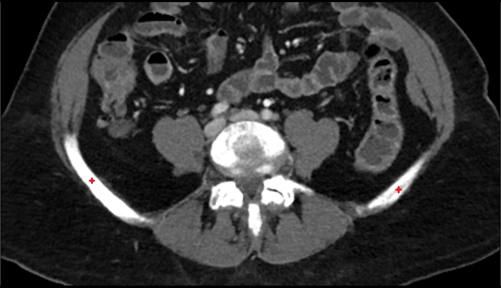 Iliac crest CT axial image