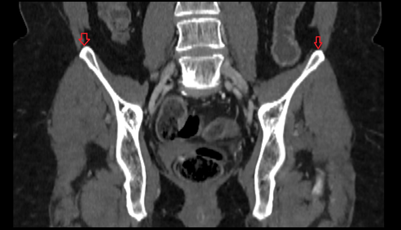 Iliac crest CT  coronal image