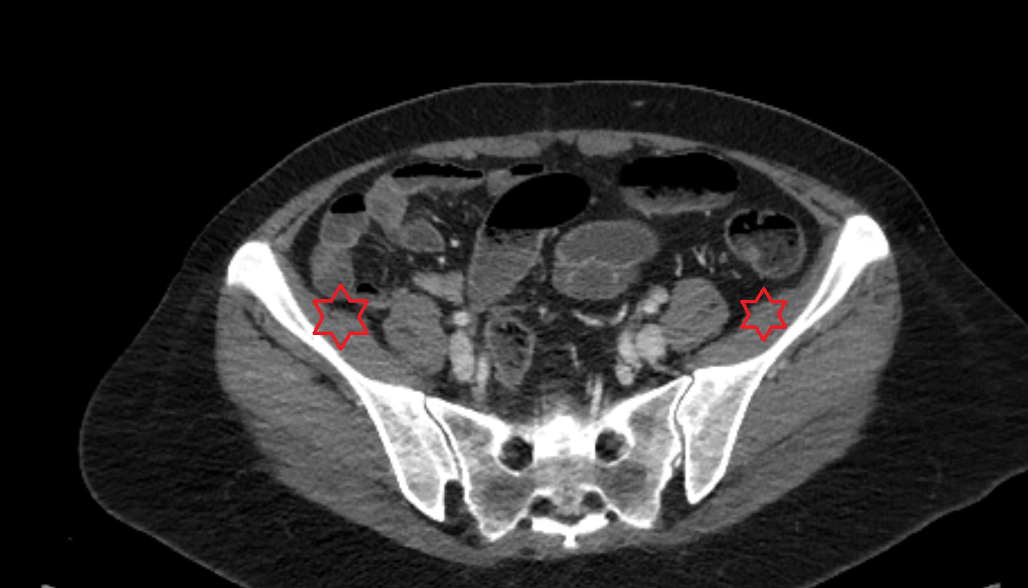 Iliac fossa ct anatomy  Location and Imaging Appearance  -img-00000-00000