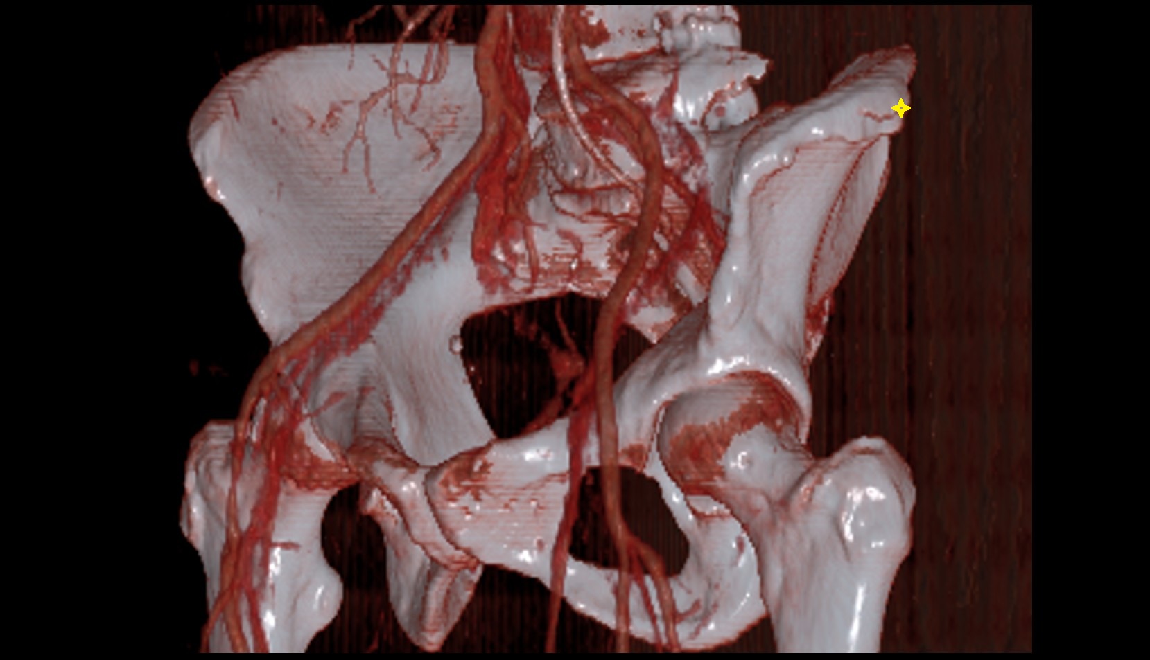 Iliac tubercle CT VRT