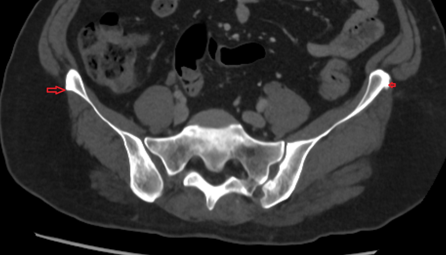 Iliac tubercle CT axial anatomy  image -img-00000-00000