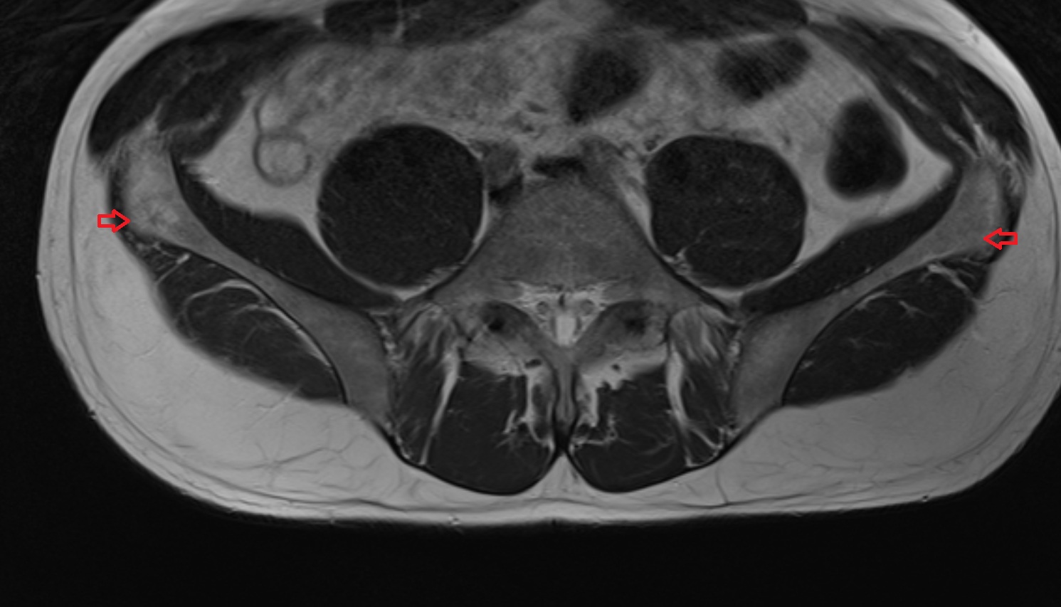 Iliac tubercle MRI axial anatomy  image -img-00000-00000