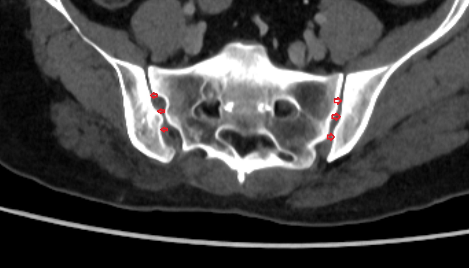Iliac tuberosity ct  axial anatomy  image-img-00000-00000