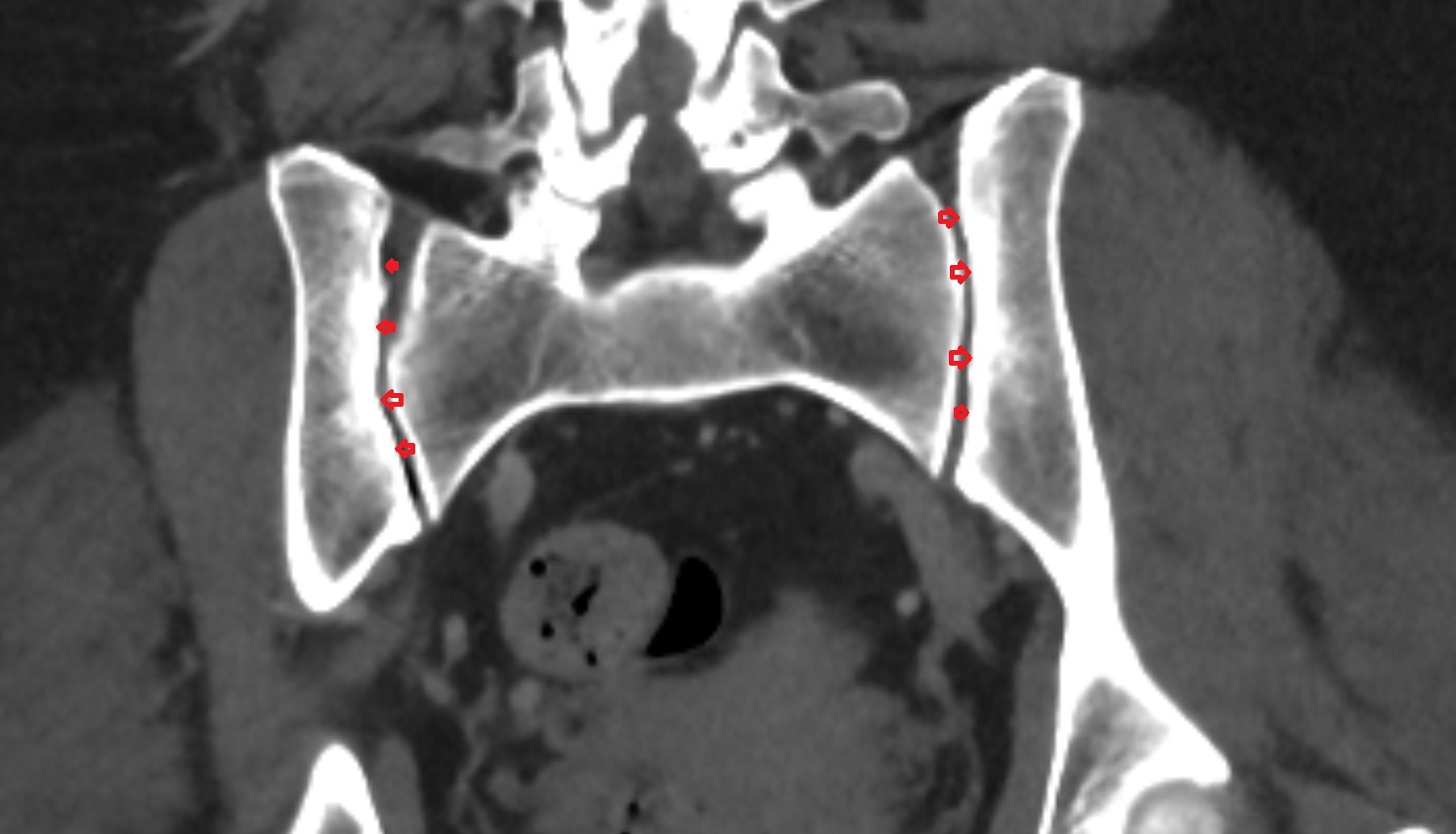 Iliac tuberosity ct  coronal anatomy  image-img-00000-00000