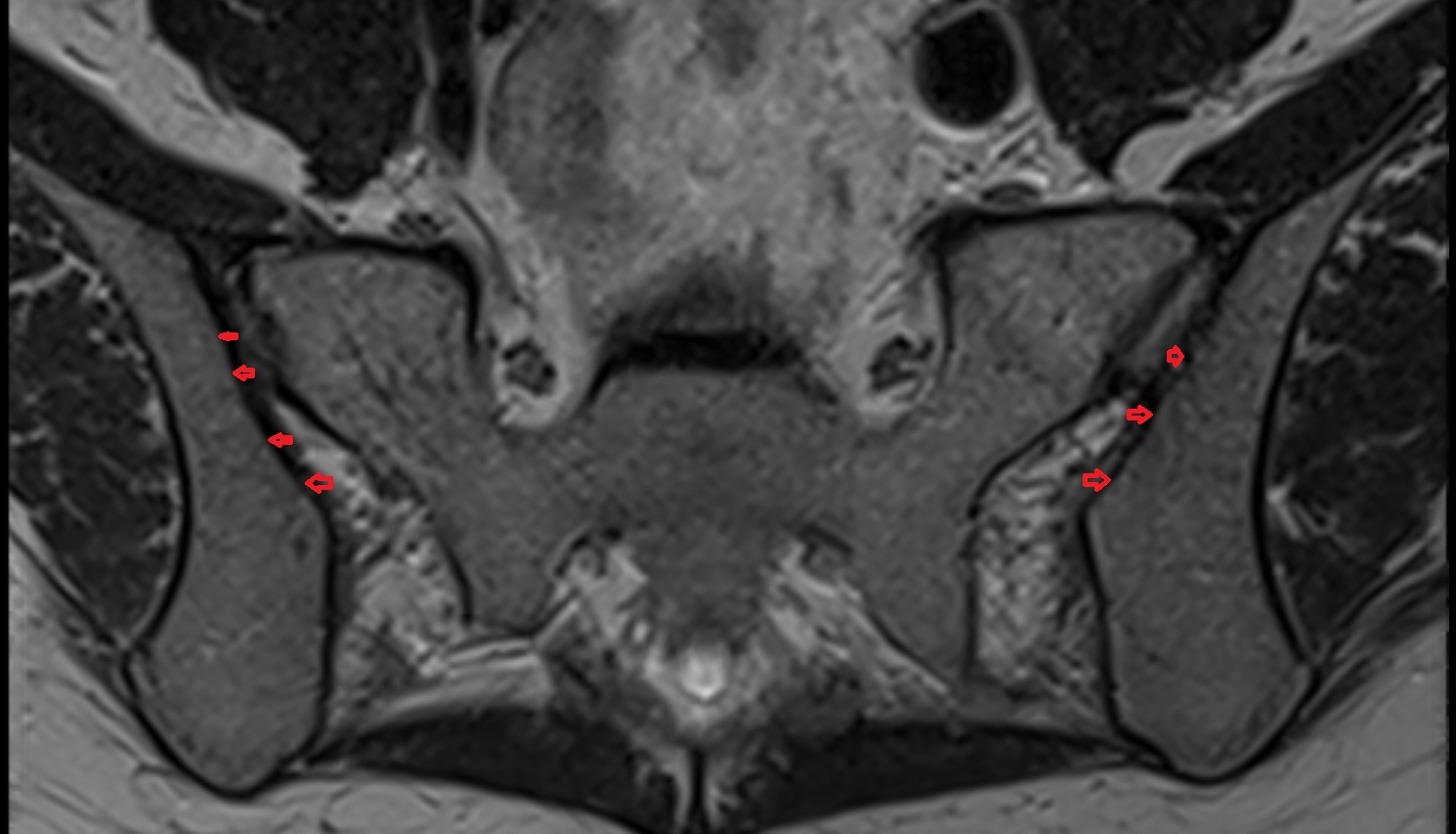 Iliac tuberosity mri  axial anatomy  image-img-00000-00000