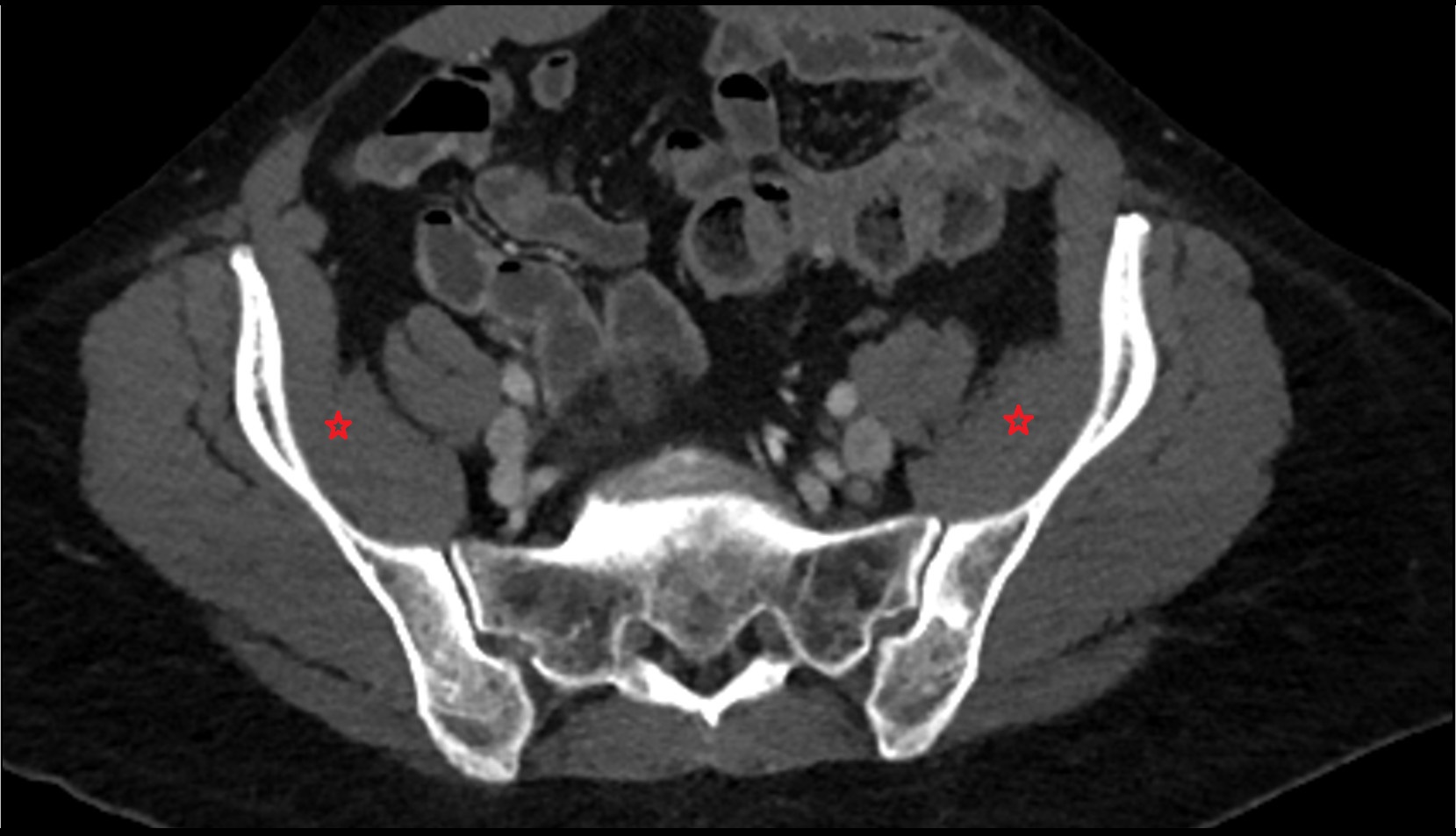 Iliacus muscle CT axial image