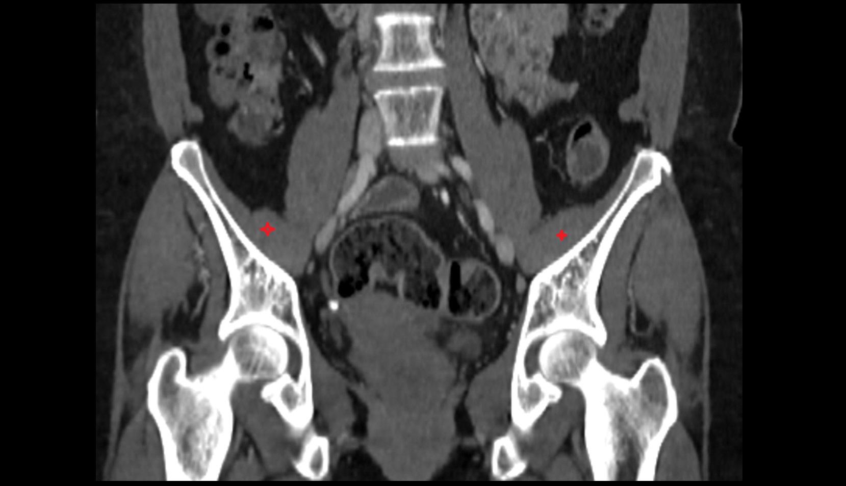 Iliacus muscle CT  coronal image