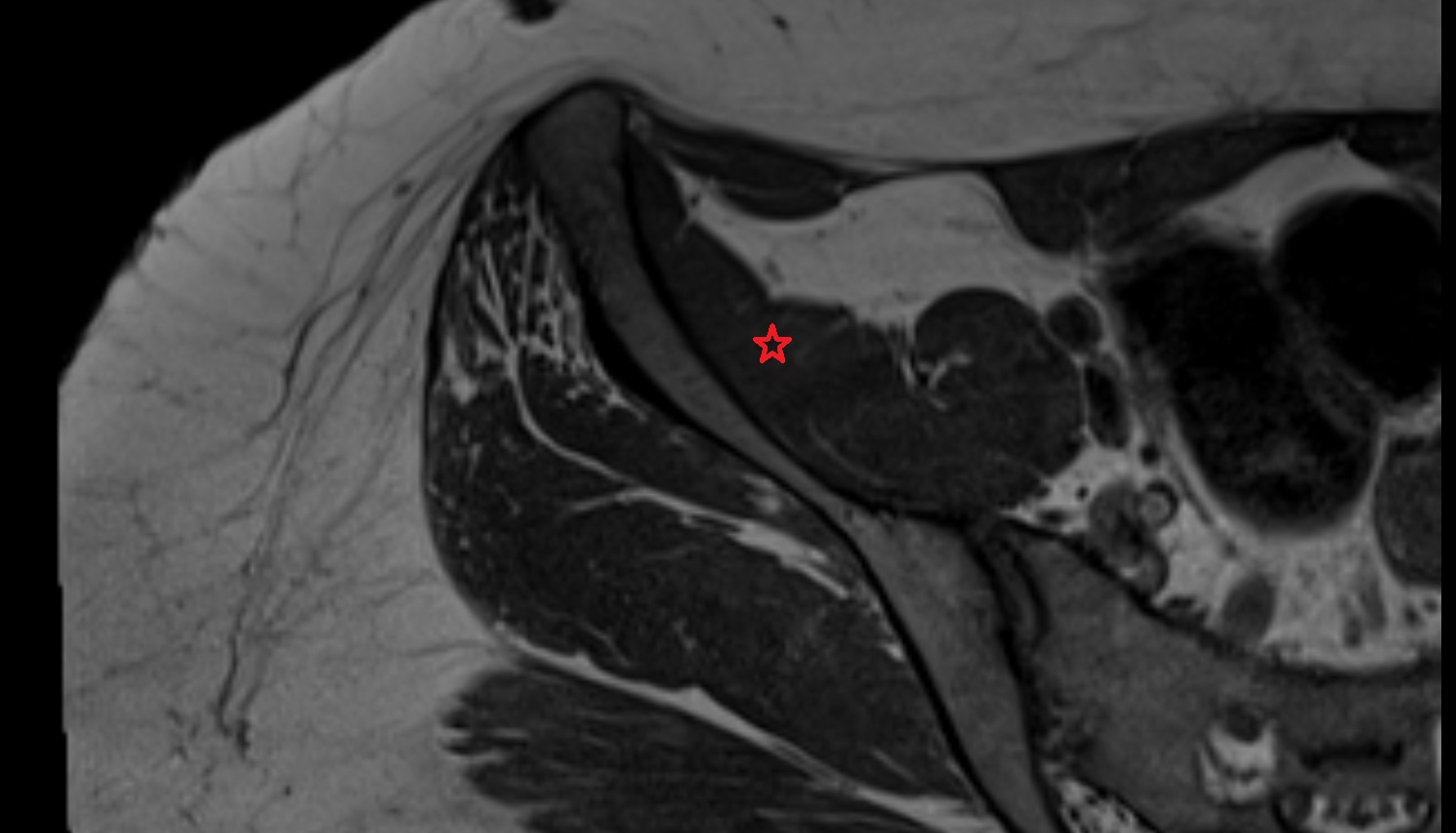 Iliacus muscle  MRI axial image anatomy  image -img-00000-00000