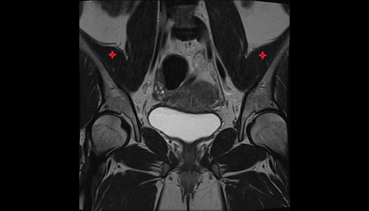 Iliacus muscle  MRI coronal image anatomy  image -img-00000-00000