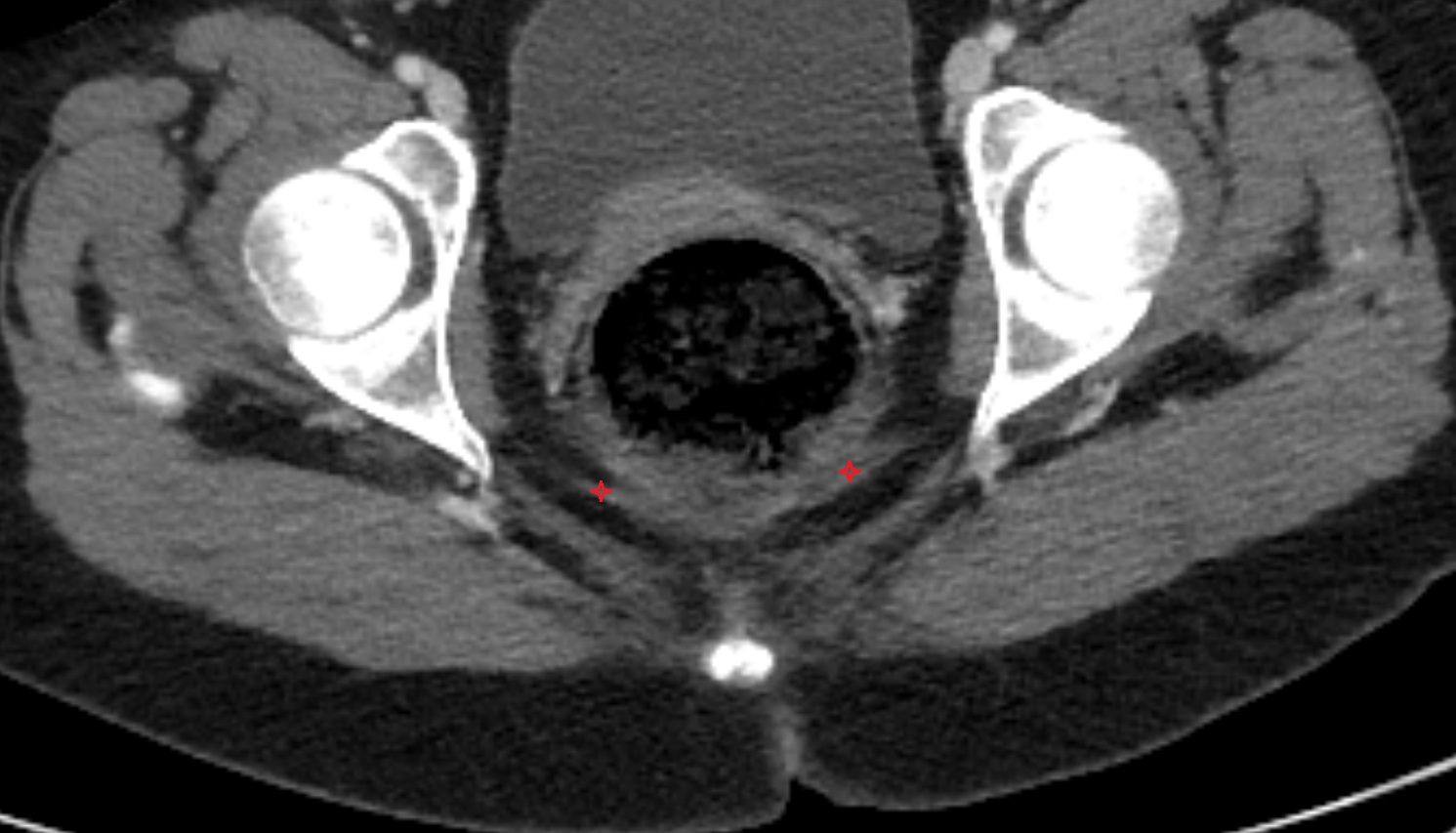 Iliococcygeus muscle  CT  axial  anatomy  image-img-00000-00000