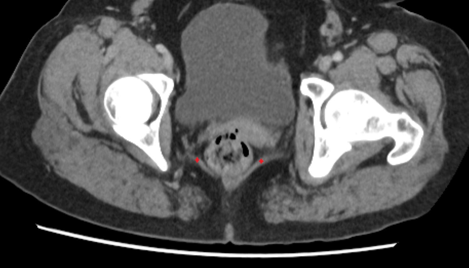 Iliococcygeus muscle  CT  axial  anatomy  image-img-00000-00000_00001