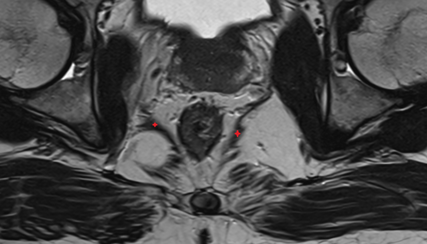 Iliococcygeus muscle MRI  axial  anatomy  image-img-00000-00000