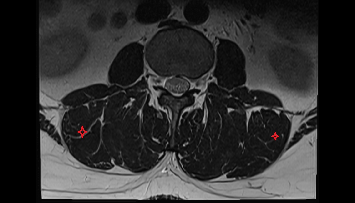 Iliocostalis lumborum muscle  MRI axial  anatomy  image-img-00000-00000