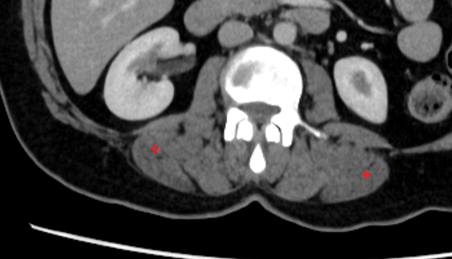 Iliocostalis lumborum muscle  ct axial  anatomy  image-img-00000-00000