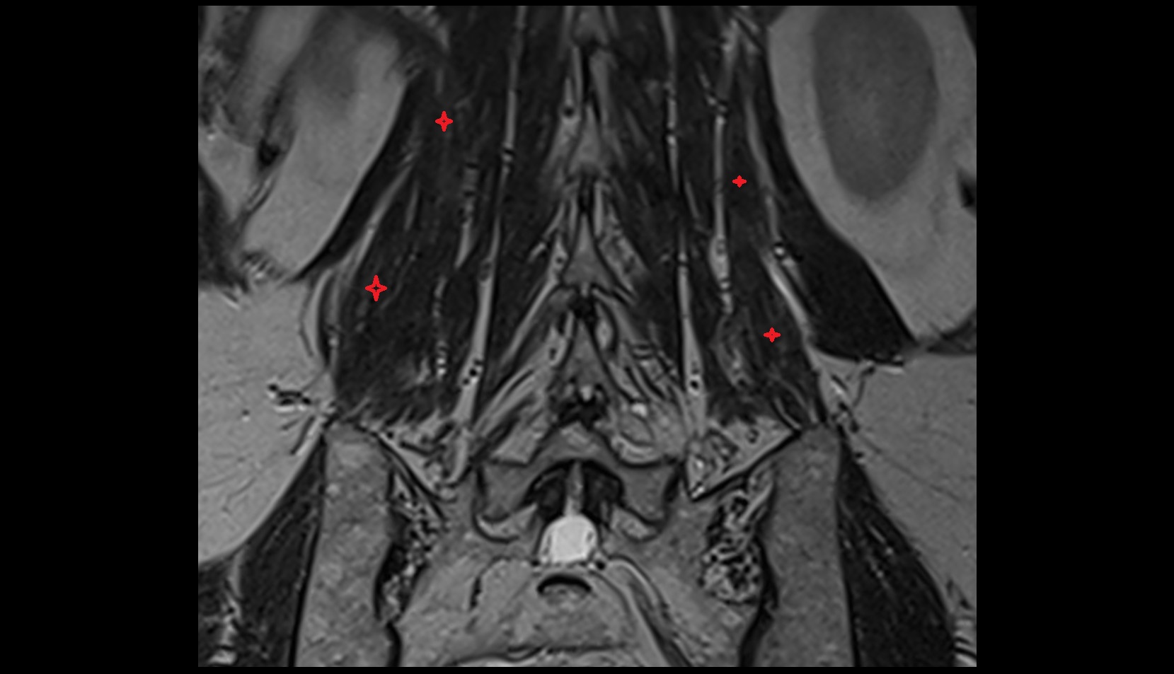 Iliocostalis lumborum muscle mri coronal image