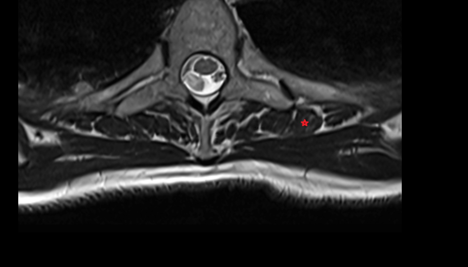Iliocostalis muscle  anatomy MRI  axial  image -img-00000-00000