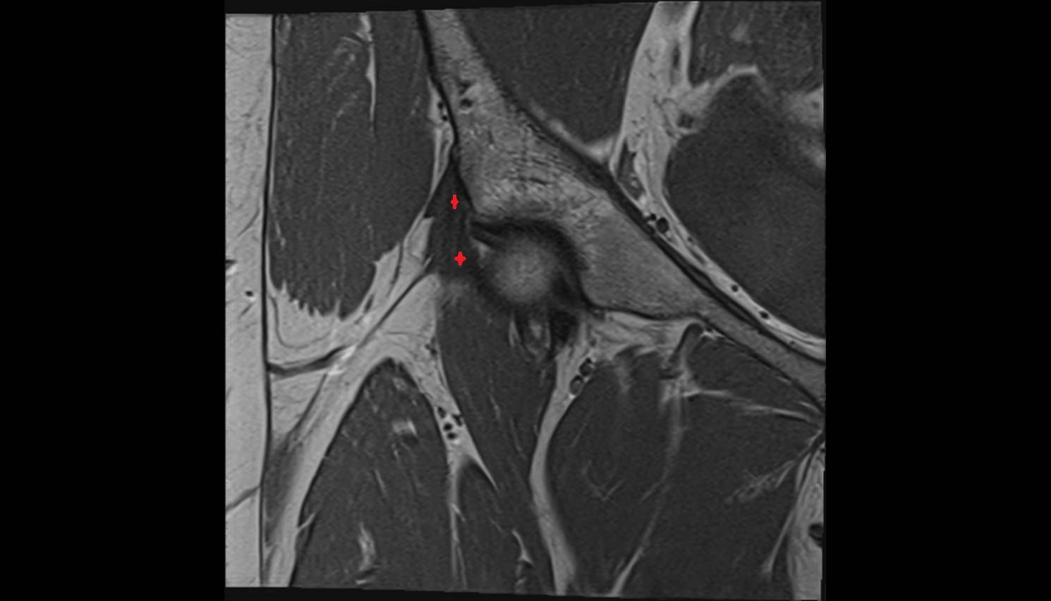 Iliofemoral Ligament inferior band (vertical band, medial band)  MRI coronal anatomy image-img-00000-00000