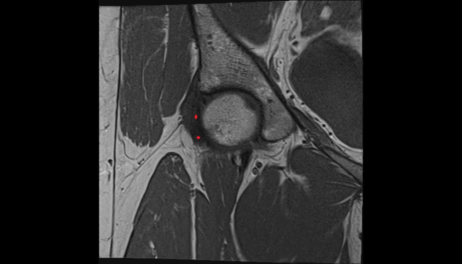 Iliofemoral Ligament inferior band (vertical band, medial band)  MRI coronal anatomy image-img-00000-00000_00001