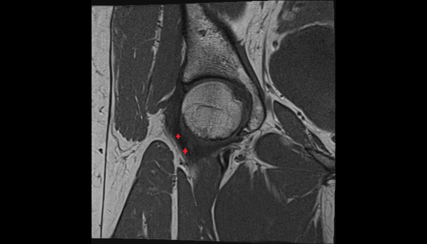 Iliofemoral Ligament inferior band (vertical band, medial band)  MRI coronal anatomy image-img-00000-00000_00002