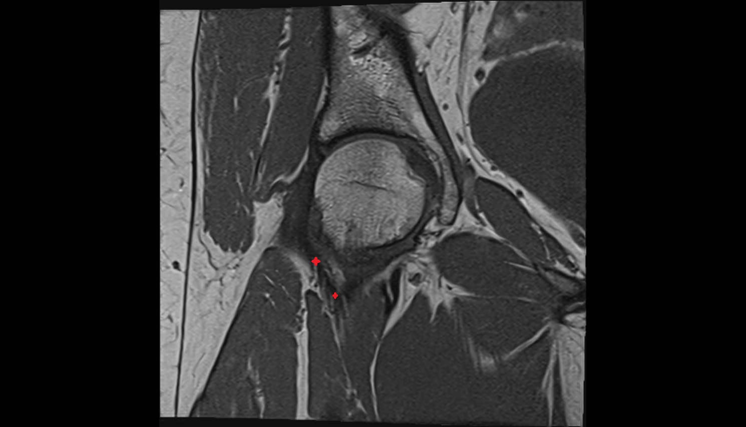 Iliofemoral Ligament inferior band (vertical band, medial band)  MRI coronal anatomy image-img-00000-00000_00003
