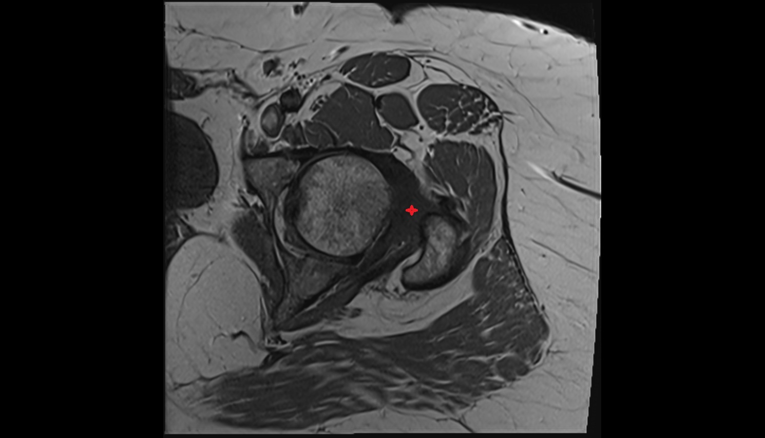 Iliofemoral Ligament superior band (transverse band, lateral band)  MRI axial  anatomy image-img-00000-00000