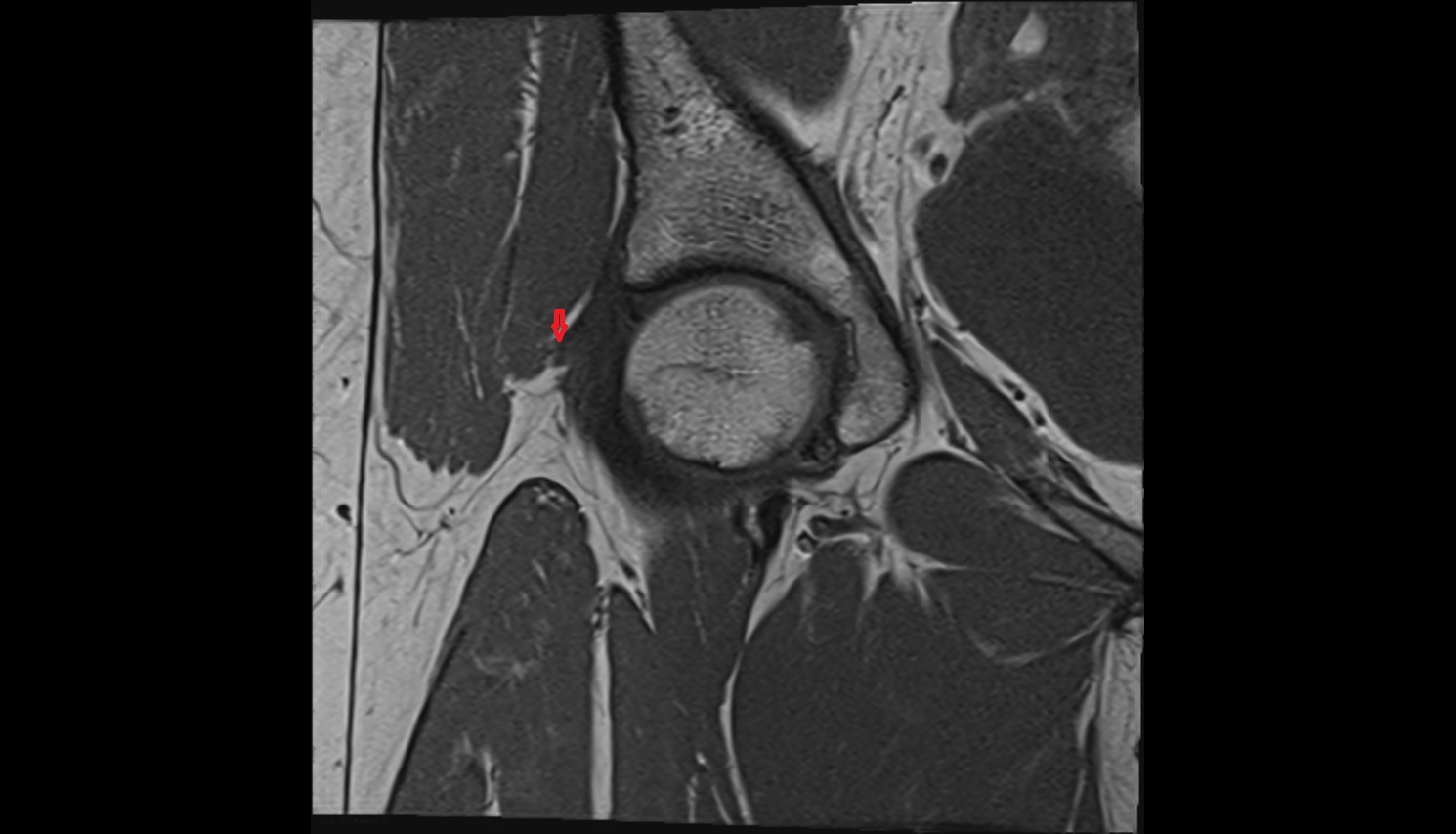 Iliofemoral Ligament superior band (transverse band, lateral band)  MRI coronal  anatomy image-img-00000-00000