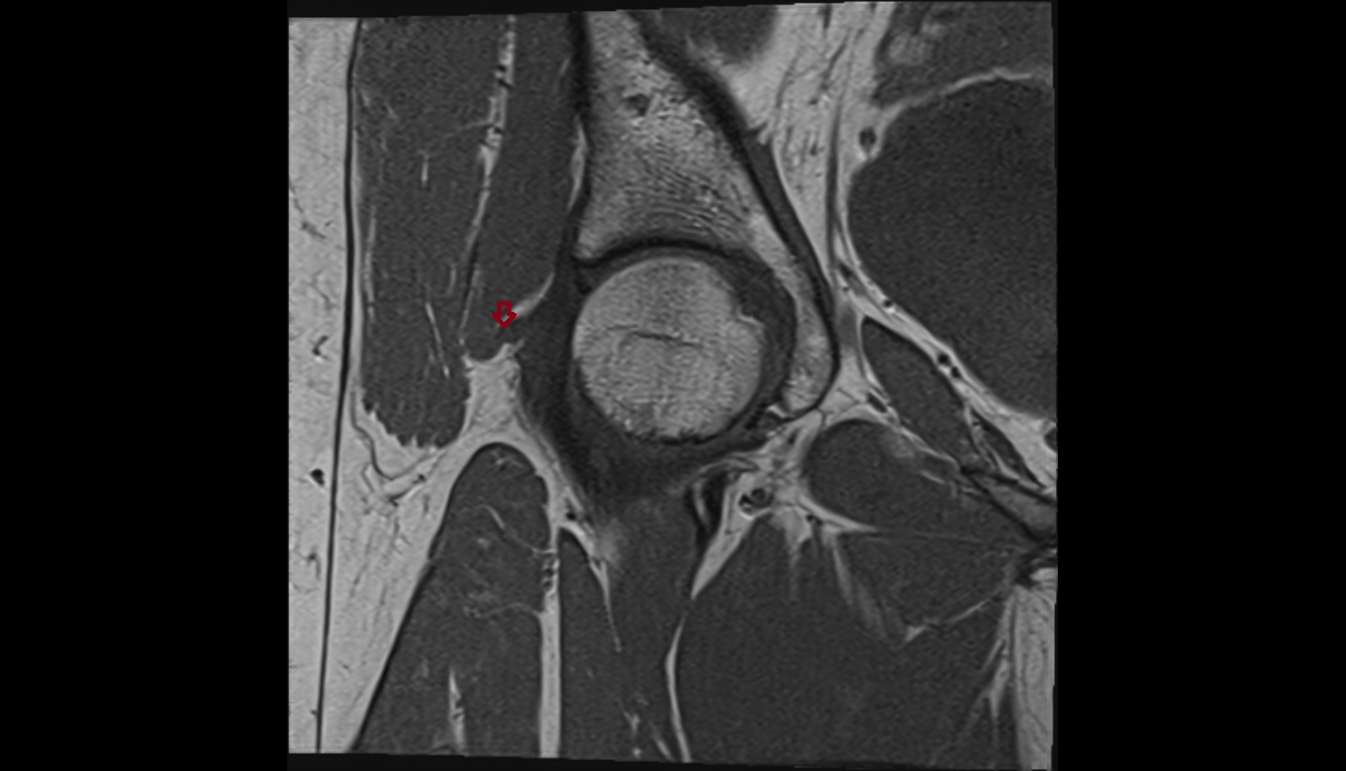 Iliofemoral Ligament superior band (transverse band, lateral band)  MRI coronal  anatomy image-img-00000-00000_00001