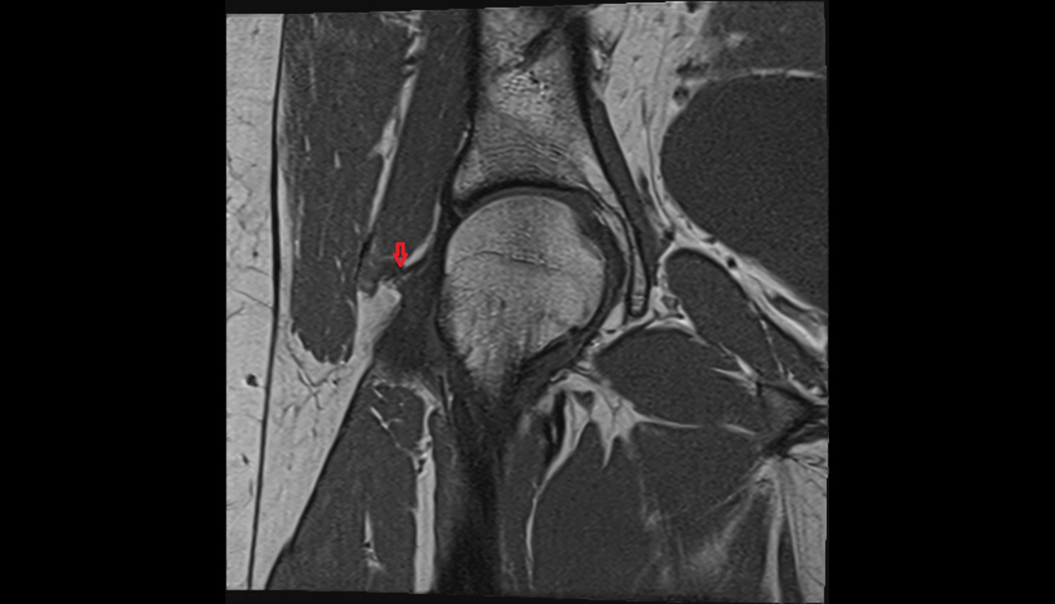 Iliofemoral Ligament superior band (transverse band, lateral band)  MRI coronal  anatomy image-img-00000-00000_00002