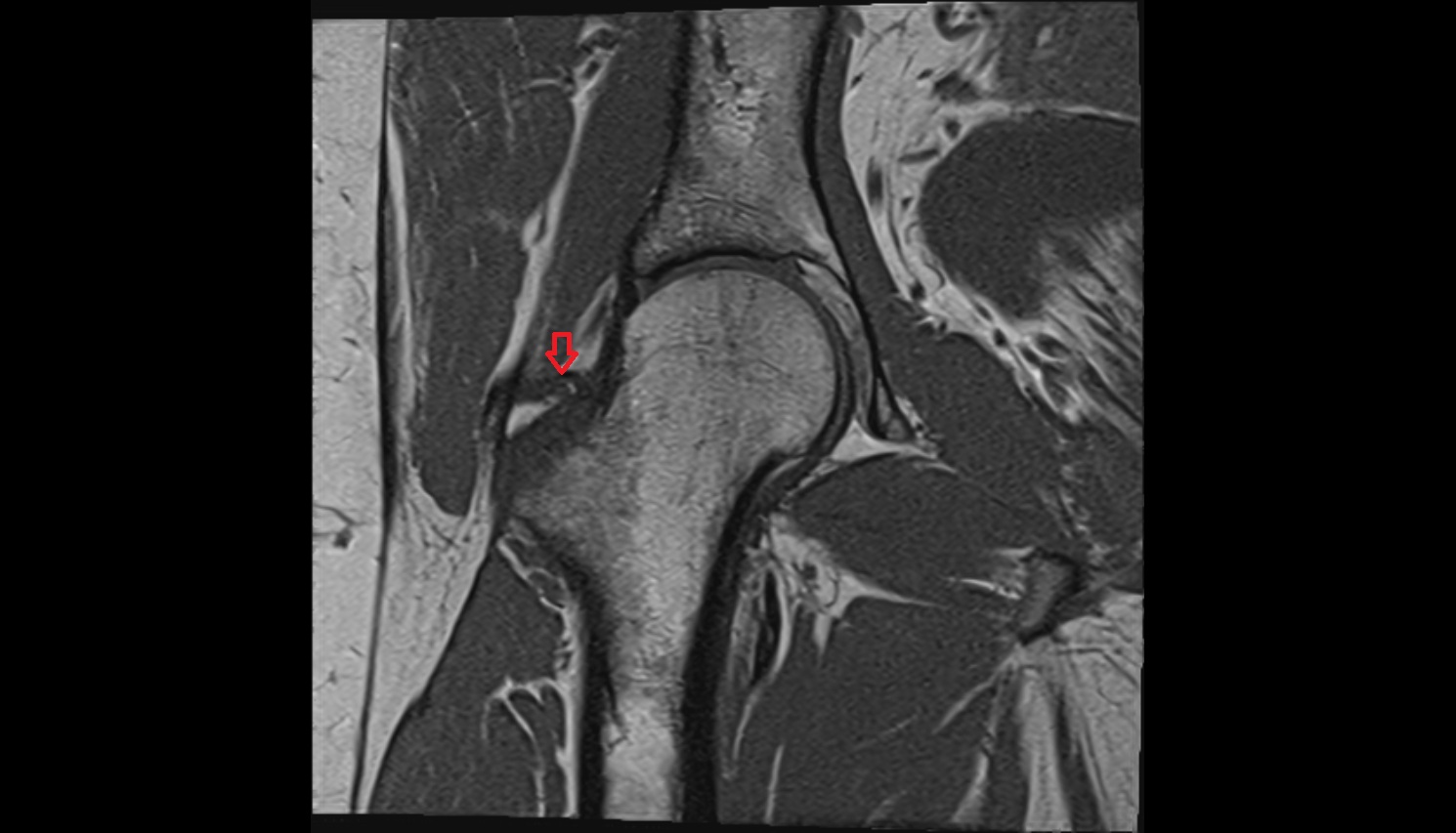 Iliofemoral Ligament superior band (transverse band, lateral band)  MRI coronal  anatomy image-img-00000-00000_00003
