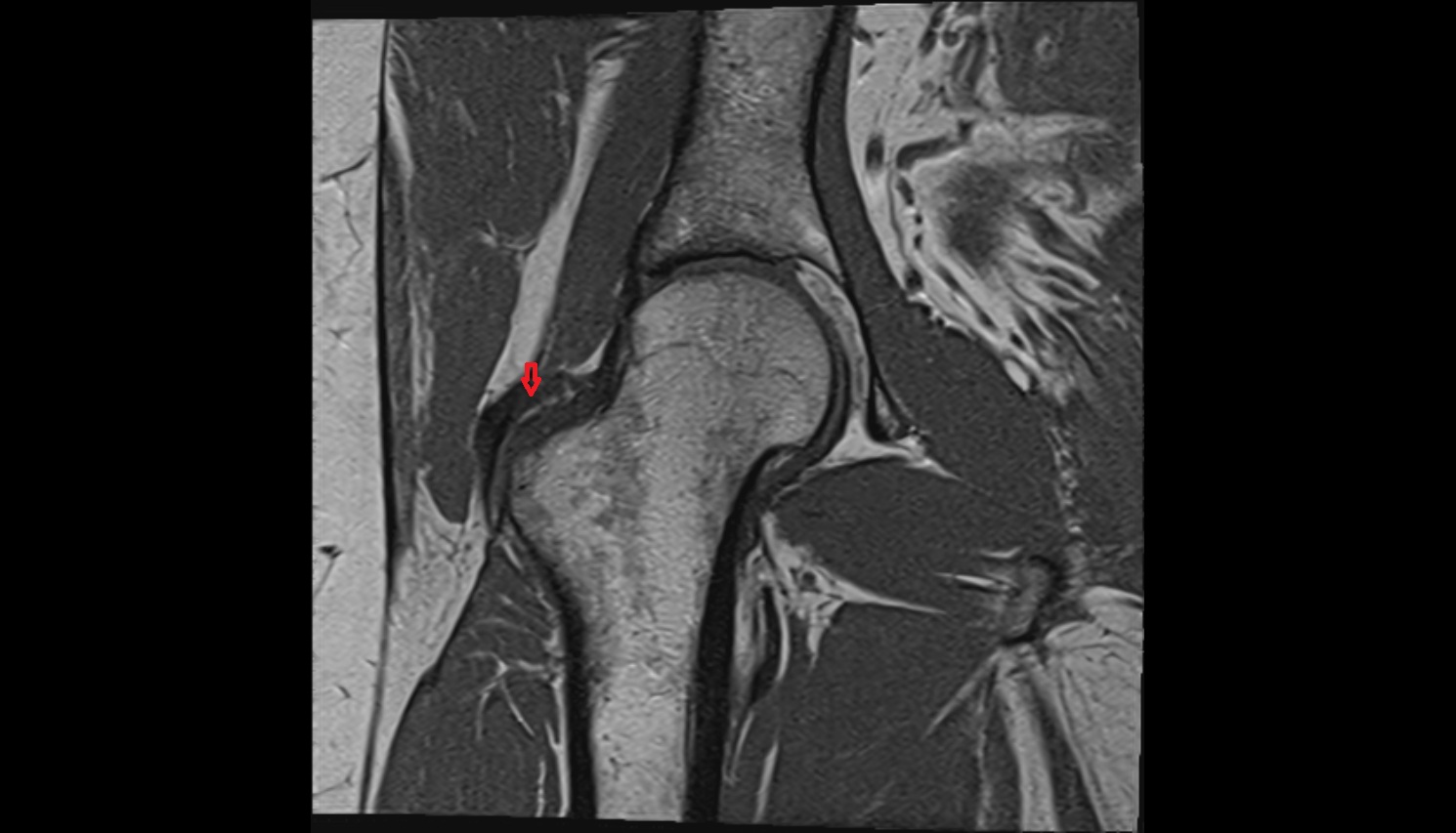 Iliofemoral Ligament superior band (transverse band, lateral band)  MRI coronal  anatomy image-img-00000-00000_00004