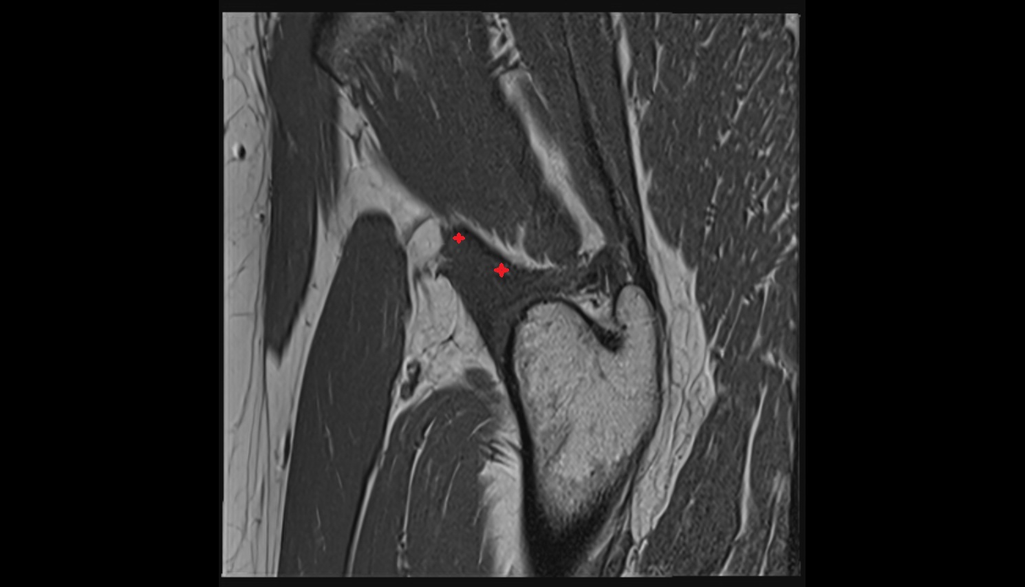 Iliofemoral Ligament superior band (transverse band, lateral band)  MRI sag anatomy image-img-00000-00000_00005