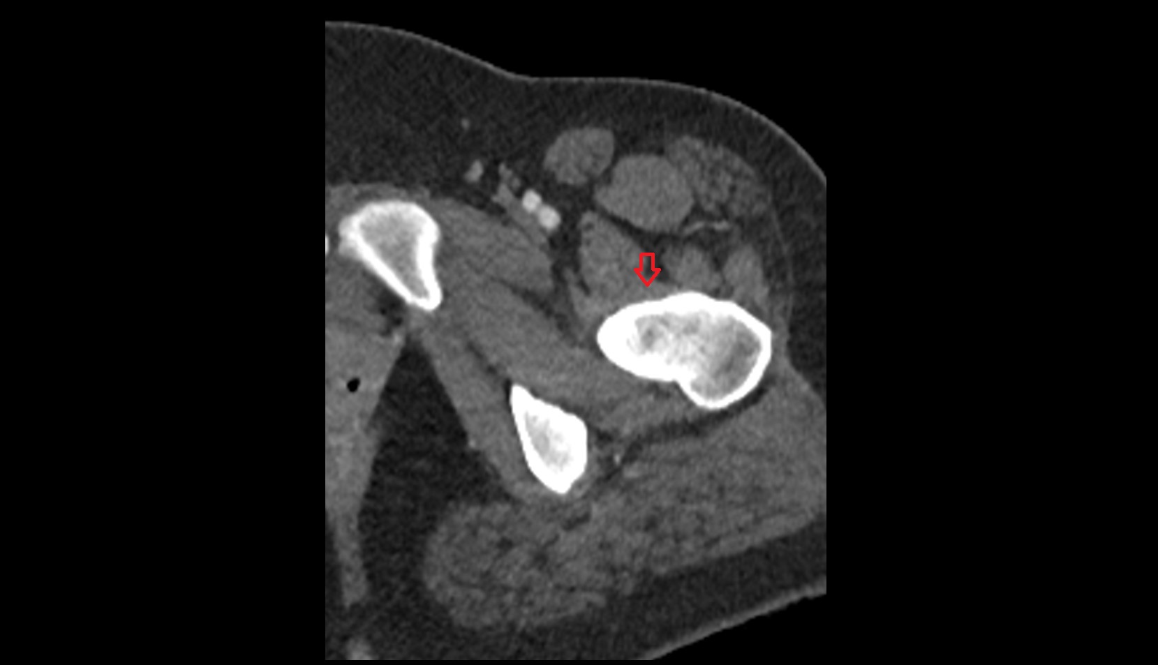 Iliofemoral ligament CT AXIAL