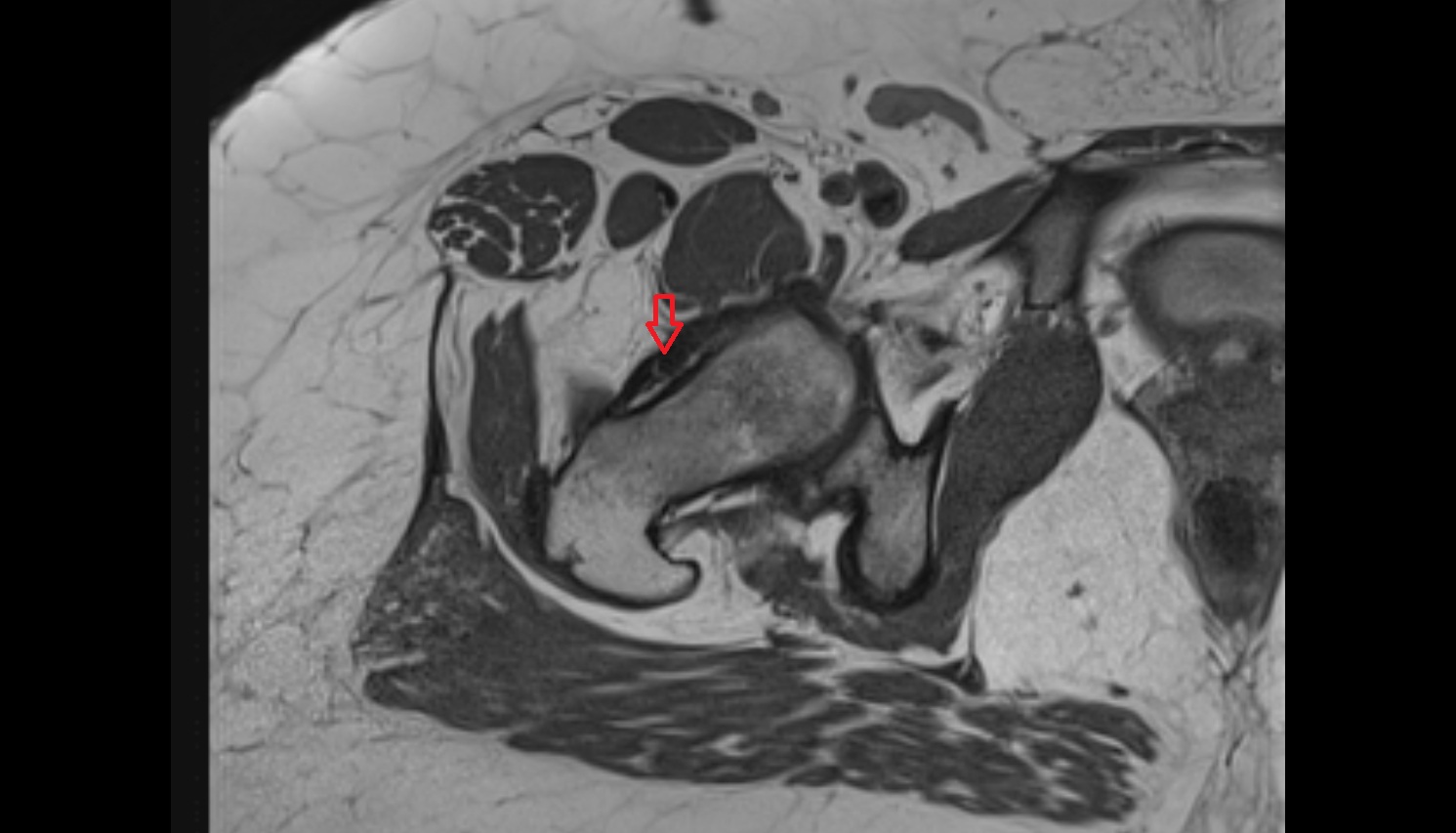 Iliofemoral ligament  axial mri anatomy  image