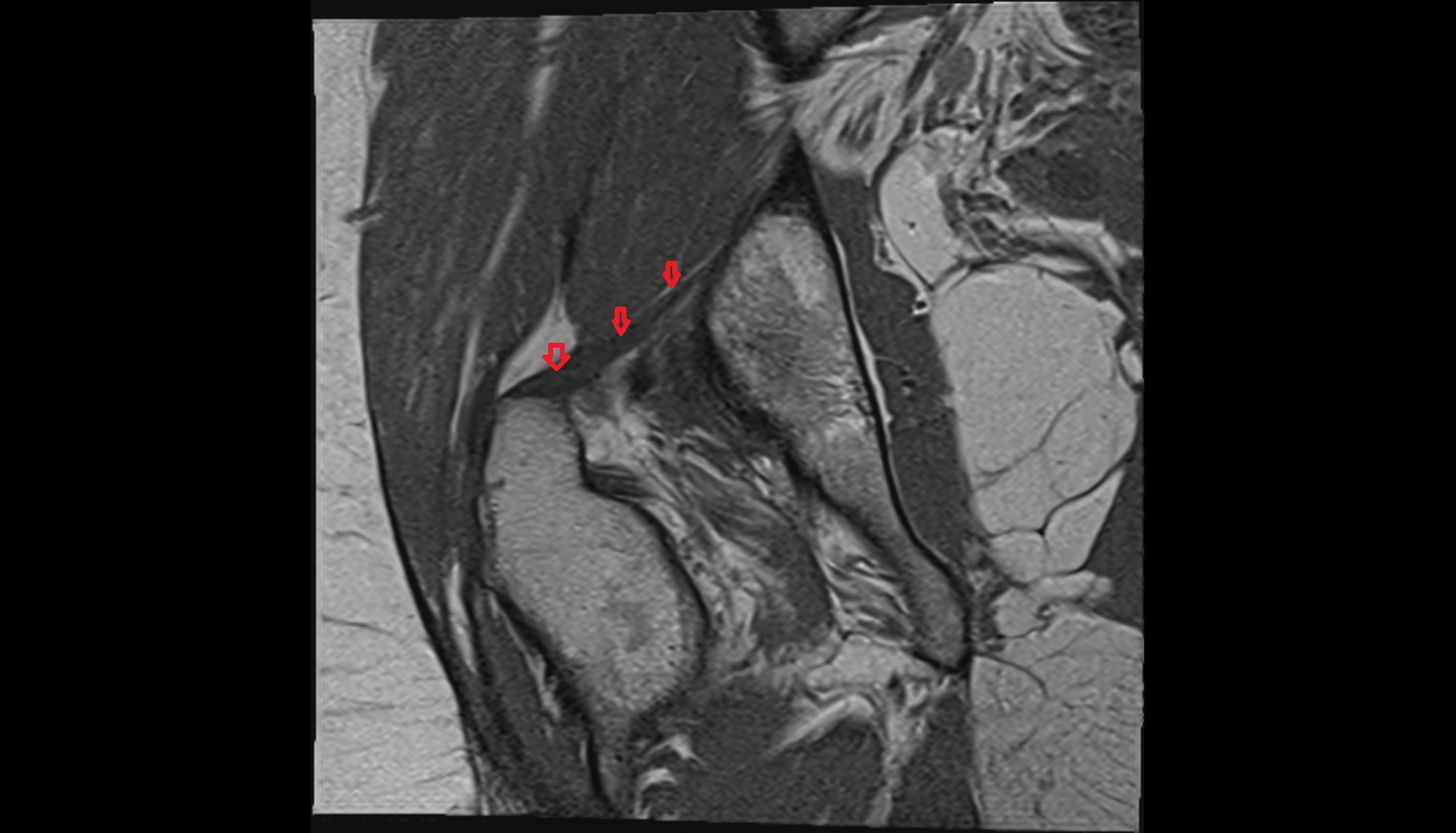 Iliofemoral ligament  MRI coronal anatomy image-img-00000-00000