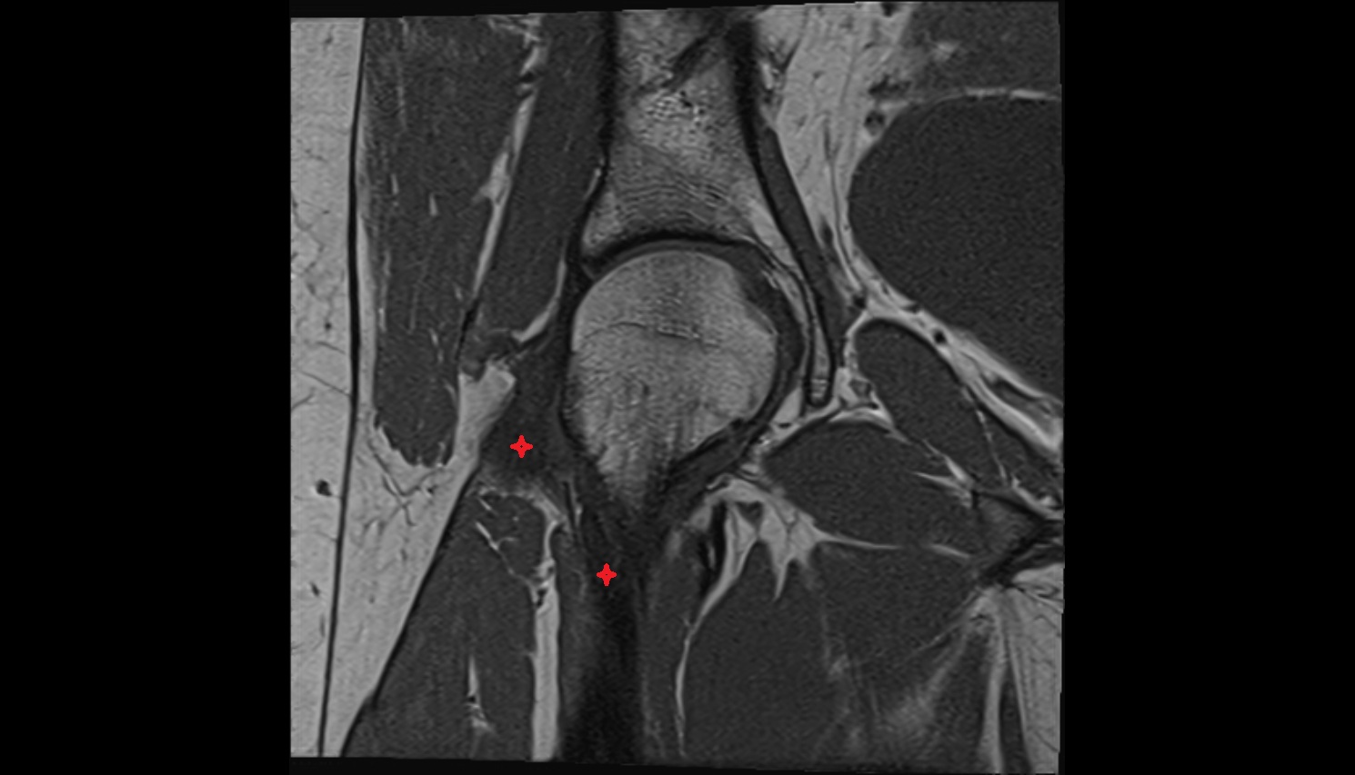 Iliofemoral ligament  MRI coronal anatomy image-img-00000-00000_00001