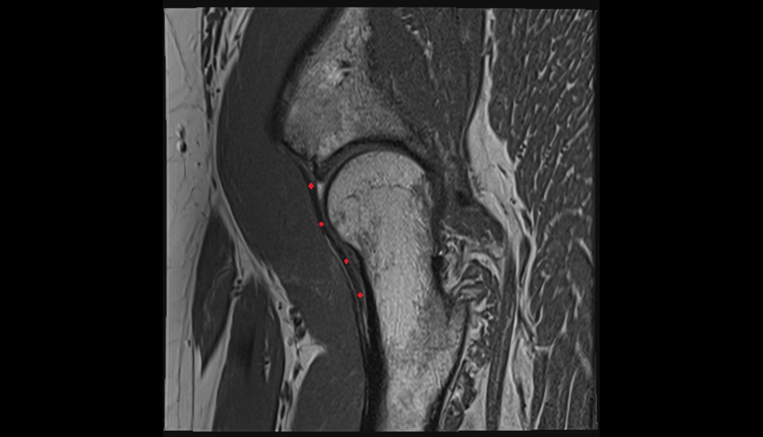 Iliofemoral ligament  MRI sag anatomy image-img-00000-00000
